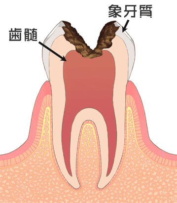 歯の神経まで進行したむし歯