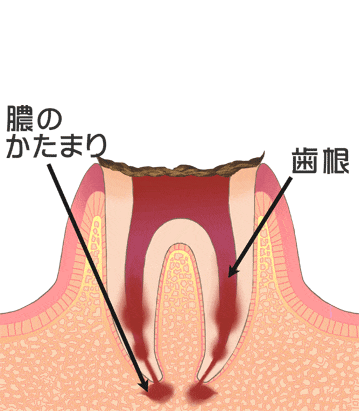 むし歯によって大きく欠けた歯