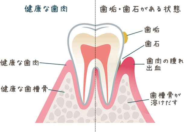 歯周病ってどんな病気？